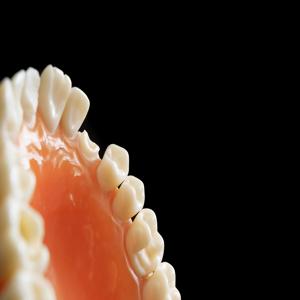 임프랑탄 충치 발생으로 인한 치아에미넌스와 치아 흔적 정도의 관계에 대해 알아보자