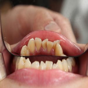 충치 예방을 위한 정기적인 치아 검진의 필요성